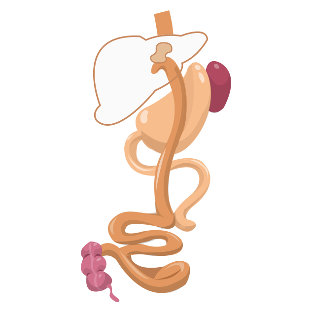 gastric bypass ilustration