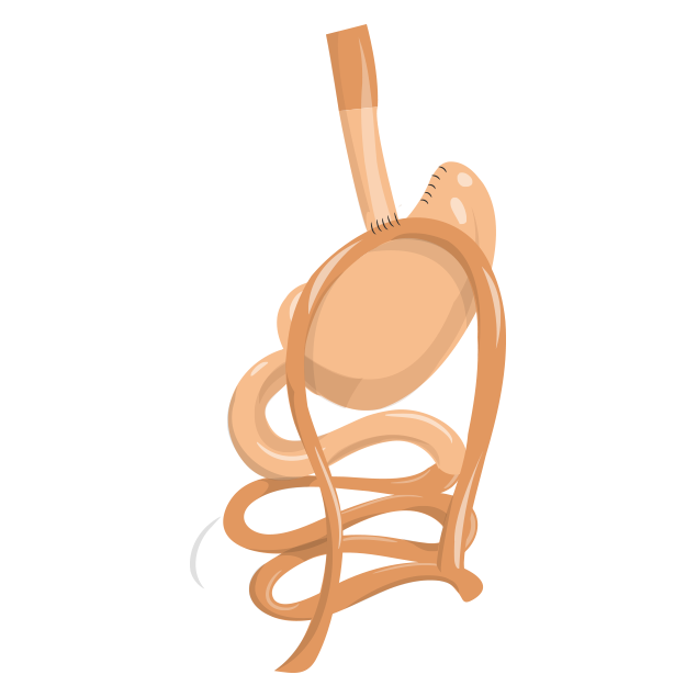 mini gastric bypass ilustration