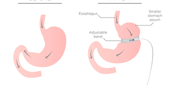 LAP-BAND® Revision to Gastric Sleeve