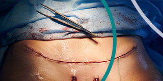 Scarring After a Tummy Tuck: Can it be Prevented?