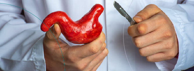 Myths about Bariatric Surgery