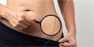 Blog how to prevent stretch marks 11