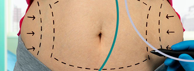 Life After Liposuction: Everything You Need to Know!