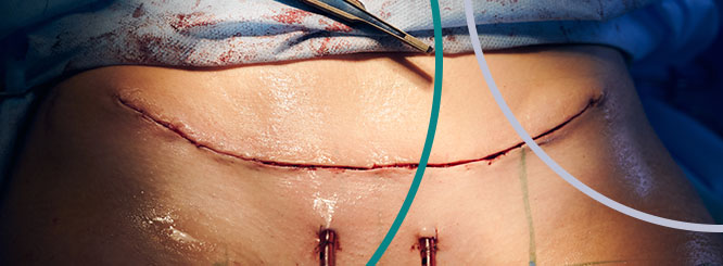 Se puede hacer una abdominoplastia en pacientes con sobrepeso? 