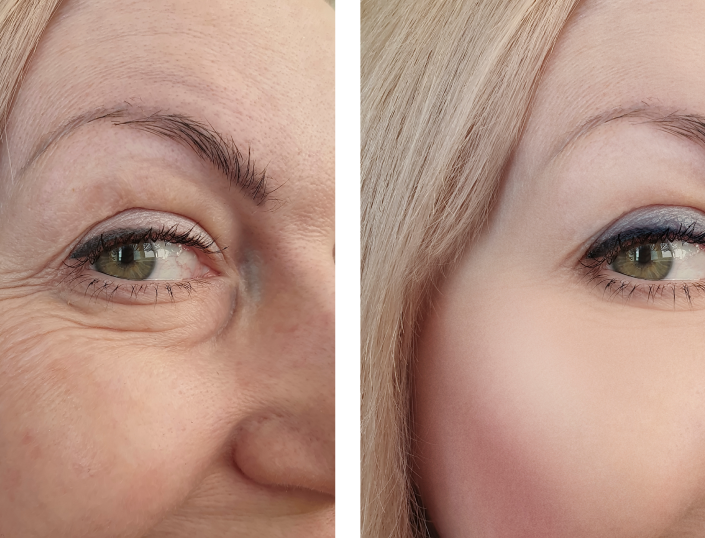 blepharoplasty tijuana